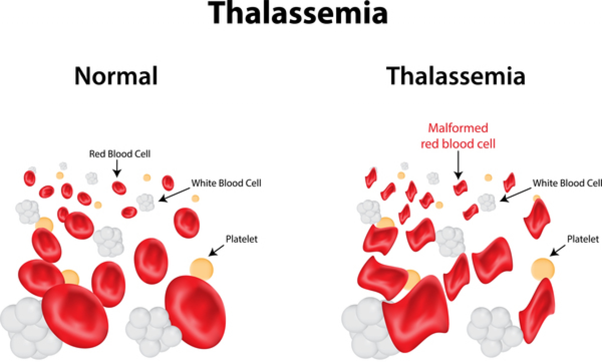 Talassemiya