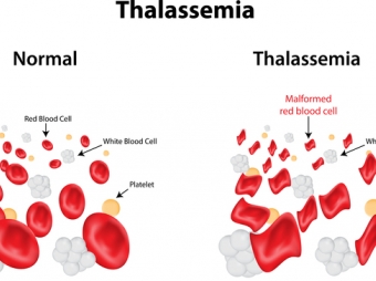 Talassemiya